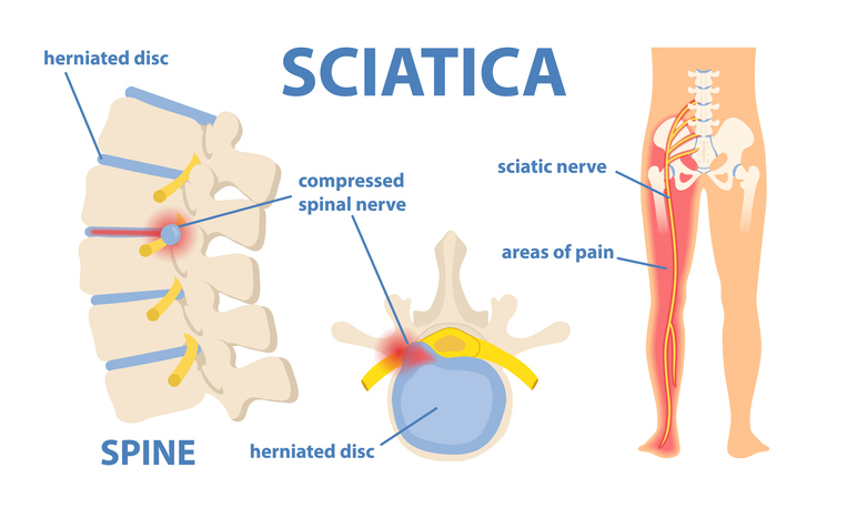 Let Us Massage Away Sciatica Pain
